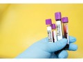 book-malaria-antigen-blood-test-in-delhi-small-0