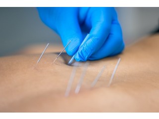 Balance Mind and Body with Anxiety Acupuncture New York City