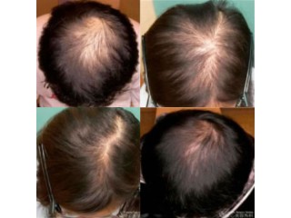 Effective Hair Loss Treatment For Women: Restore Confidence And Healthy Hair