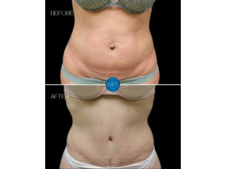 Tummy Tuck Plastic Surgeon Near Me