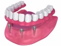 dental-implants-emergency-small-0
