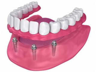 Dental Implants Emergency