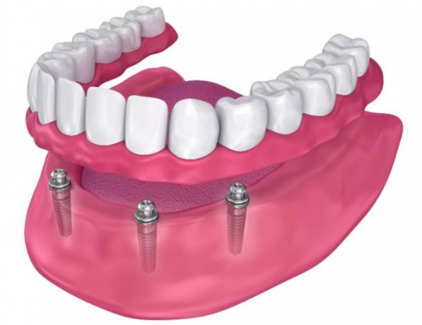 dental-implants-emergency-big-0
