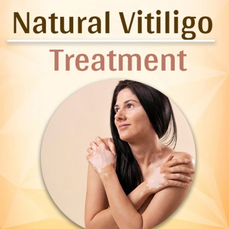 vitiligo-homeopathic-treatmentwhite-spot-on-skin-big-0