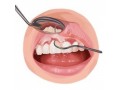 dental-implants-cost-full-mouth-restoration-small-0