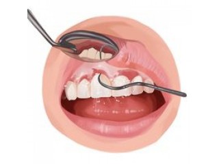 Dental Implants Cost Full Mouth Restoration