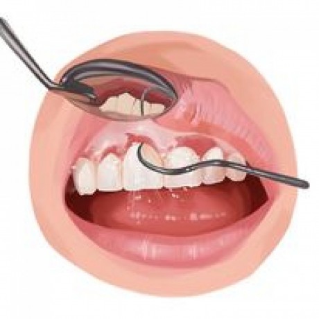 dental-implants-cost-full-mouth-restoration-big-0