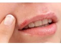 say-goodbye-to-herpes-symptoms-with-acivir-cream-small-0