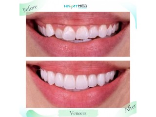 Teeth Veneers Turkey