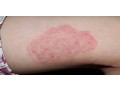 benzaclin-your-result-for-acne-purchase-securely-for-clearer-skin-small-0