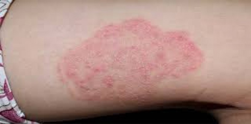 benzaclin-your-result-for-acne-purchase-securely-for-clearer-skin-big-0