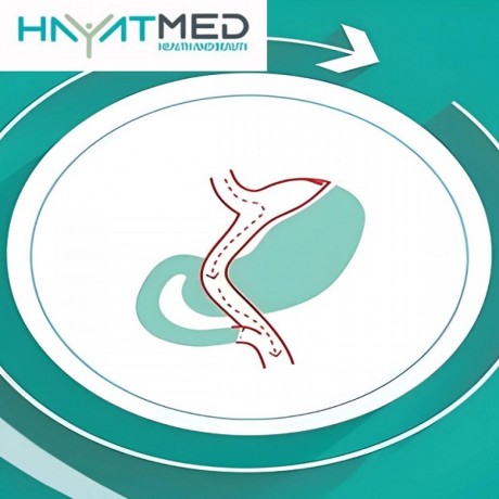 gastric-sleeve-surgery-turkey-big-0